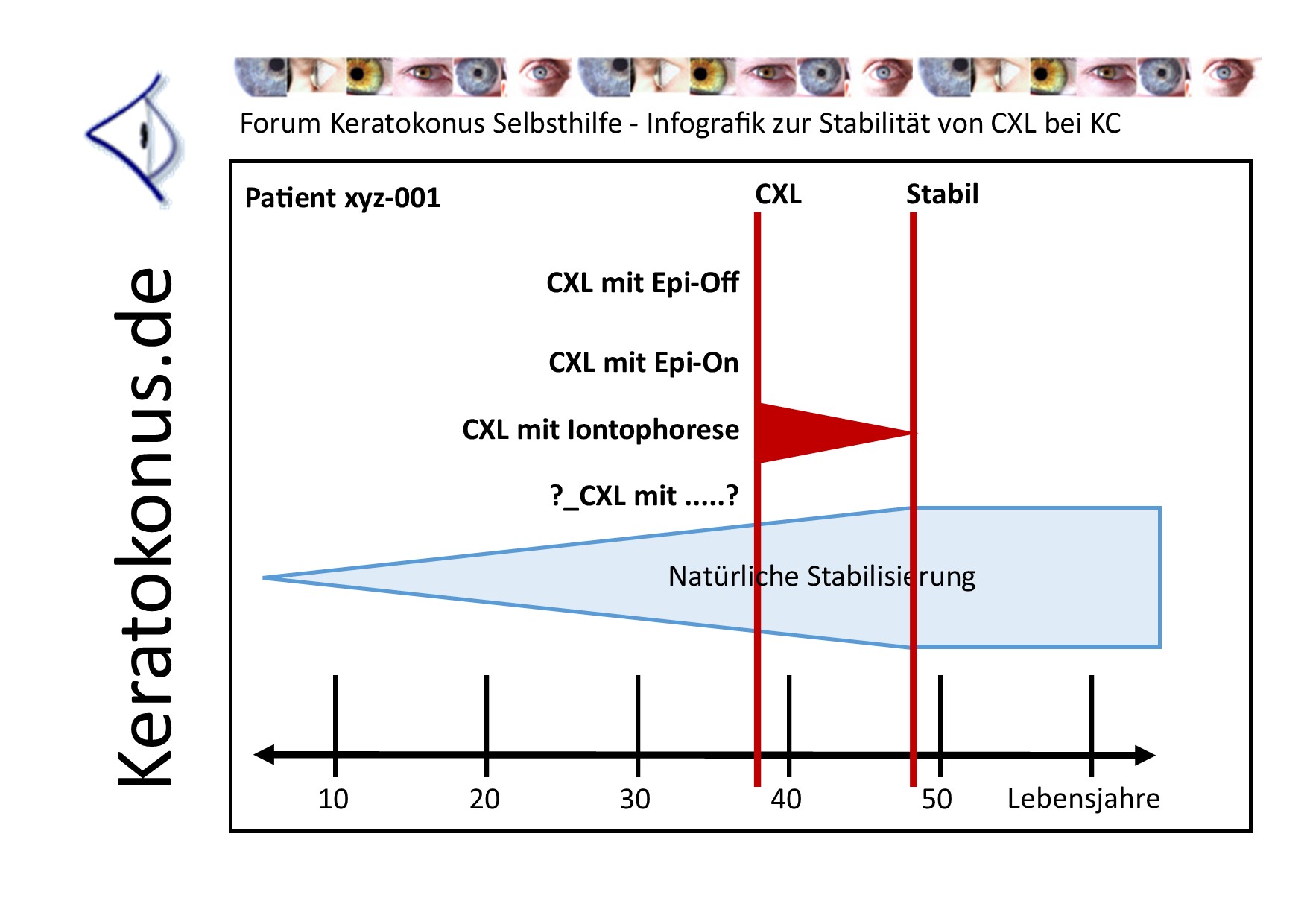 KC copyright by Keratokonus de how long lasts clx 001 pt01