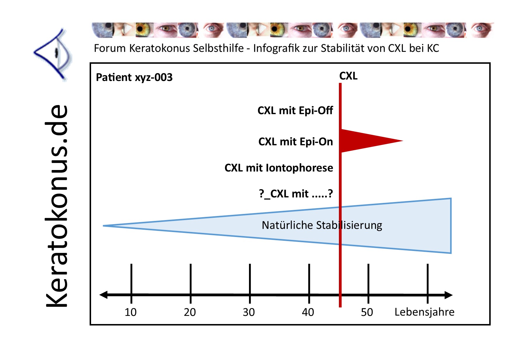 KC copyright by Keratokonus de how long lasts clx 001 pt03